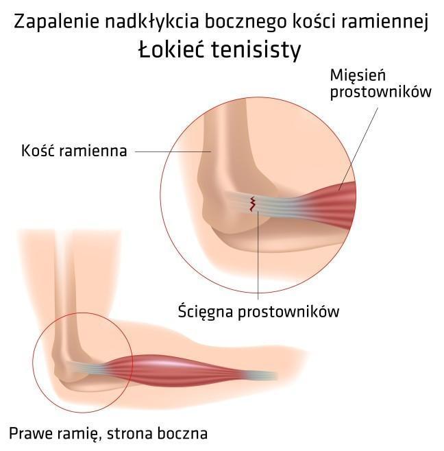 Łokieć tenisisty