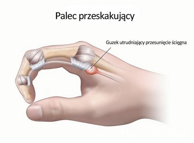 Palec przeskakujący