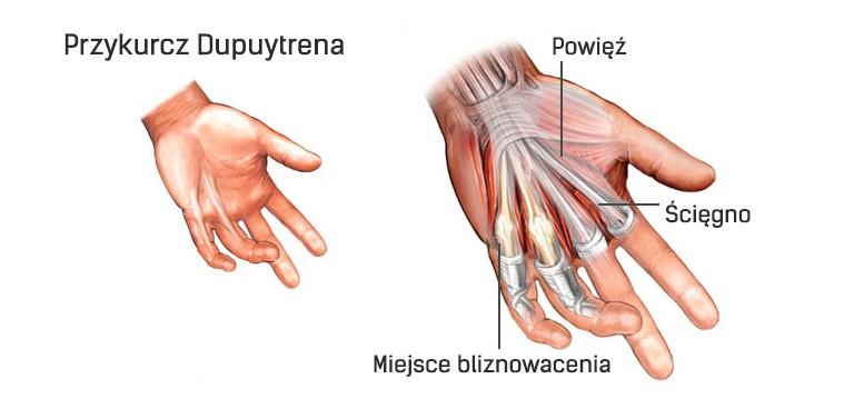 Przykurcz Dupuytrena